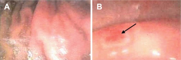 Potentiated clinoptilolite: artificially enhanced aluminosilicate reduces symptoms associated with endoscopically negative gastroesophageal reflux disease and nonsteroidal anti-inflammatory drug induced gastritis